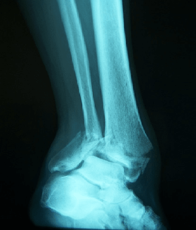 X-ray Result of the Damage Foot