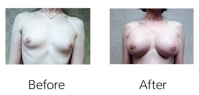 Transgender Breast Augmentation