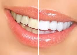 After a completed dentist tooth whitening project in the  area