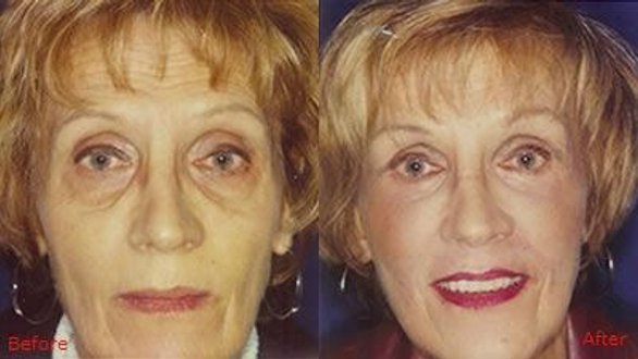 Blepharoplasty Before and After
