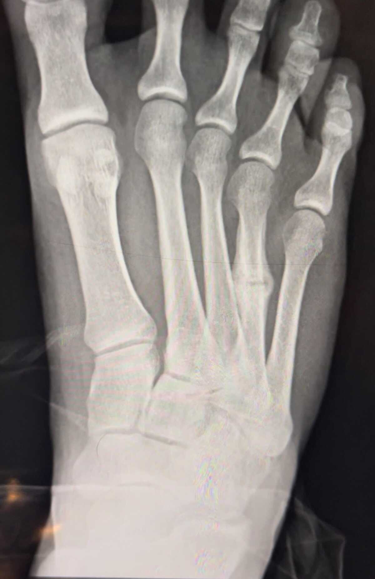 stress-fracture-metatarsal